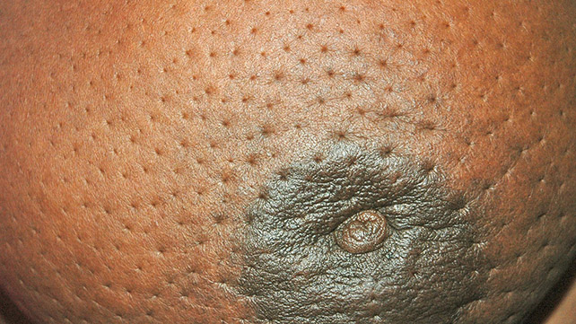 Breast Cancer in Africa: Learn how to detect it early.