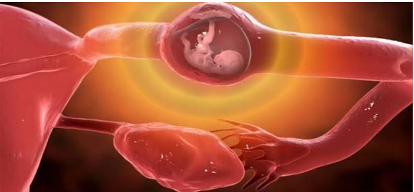 Ectopic pregnancy: why this emergency is silently killing young women