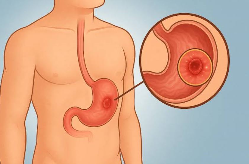 What causes stomach ulcers? Debunking 5 common Nigerian myths