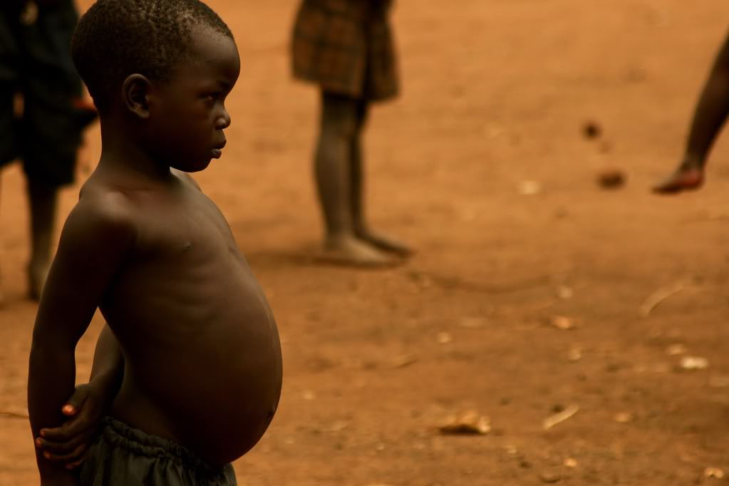 Malnutrition in African children: the warning signs every parent should know